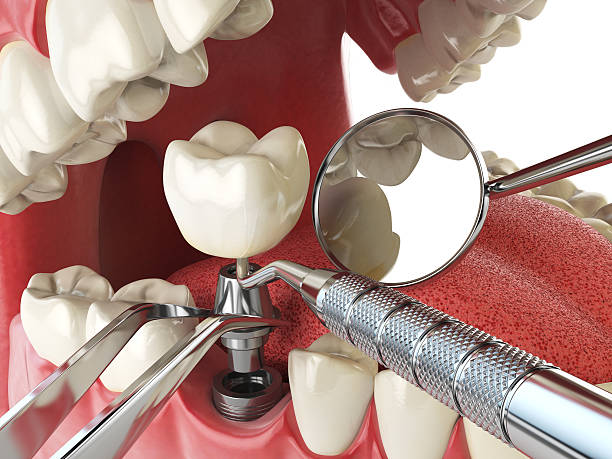Best Emergency Tooth Extraction in K I Sawyer, MI